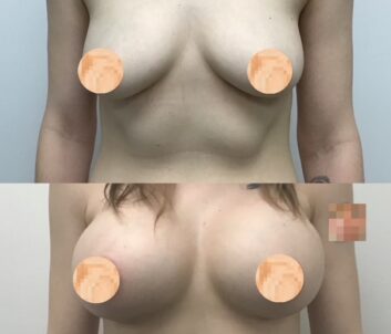 Before and After Breast Augmentation - Lift at Face Works Plastic Surgery, Plastic Surgeon Near Me in Schaumburg, IL