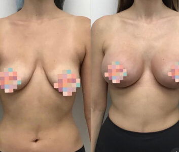 Before and After Breast Augmentation - Lift at Face Works Plastic Surgery, Plastic Surgeon Near Me in Schaumburg, IL