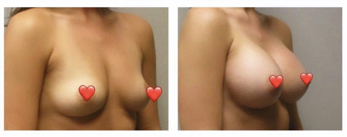 Before and After Breast Augmentation - Lift at Face Works Plastic Surgery, Plastic Surgeon Near Me in Schaumburg, IL