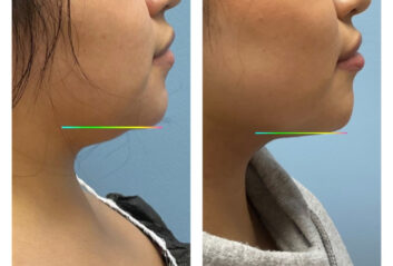 Before and After HD LipoX® of Jawline at Face Works Plastic Surgery, Plastic Surgeon Near Me in Schaumburg, IL Before and After HD LipoX® of Jawline at Face Works Plastic Surgery, Plastic Surgeon Near Me in Schaumburg, IL