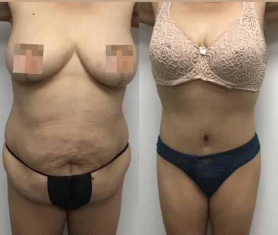 Tummy Tuck at Face Works Plastic Surgery, Plastic Surgeon Near Me in Schaumburg, IL Tummy Tuck at Face Works Plastic Surgery, Plastic Surgeon Near Me in Schaumburg, IL