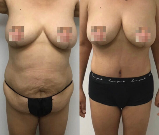 Tummy Tuck at Face Works Plastic Surgery, Plastic Surgeon Near Me in Schaumburg, IL Tummy Tuck at Face Works Plastic Surgery, Plastic Surgeon Near Me in Schaumburg, IL