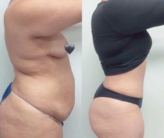 Tummy Tuck at Face Works Plastic Surgery, Plastic Surgeon Near Me in Schaumburg, IL Tummy Tuck at Face Works Plastic Surgery, Plastic Surgeon Near Me in Schaumburg, IL