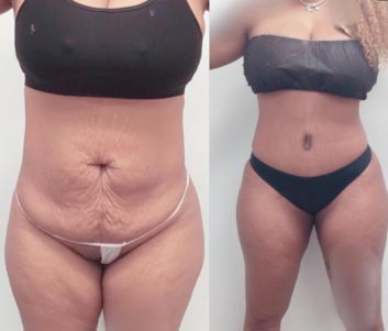 Before and After Tummy Tuck at Face Works Plastic Surgery, Plastic Surgeon Near Me in Schaumburg, IL