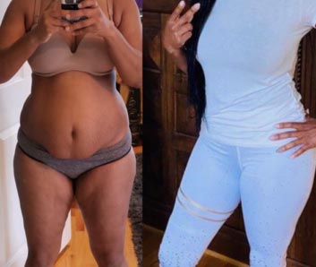 Before and After Tummy Tuck at Face Works Plastic Surgery, Plastic Surgeon Near Me in Schaumburg, IL