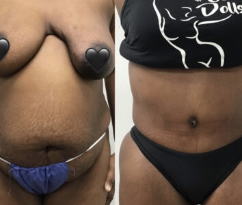 Before and After Tummy Tuck at Face Works Plastic Surgery, Plastic Surgeon Near Me in Schaumburg, IL