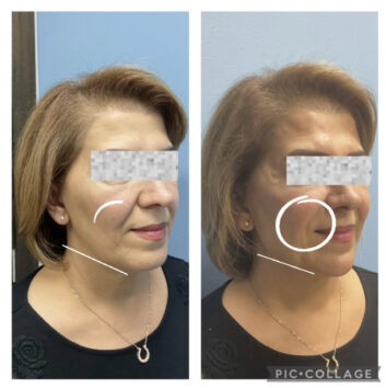 Dermal fillers at Face Works Plastic Surgery, Plastic Surgeon Near Me in Schaumburg, IL Dermal fillers at Face Works Plastic Surgery, Plastic Surgeon Near Me in Schaumburg, IL