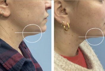 Before and After HD LipoX® of Jawline at Face Works Plastic Surgery, Plastic Surgeon Near Me in Schaumburg, IL Before and After HD LipoX® of Jawline at Face Works Plastic Surgery, Plastic Surgeon Near Me in Schaumburg, IL