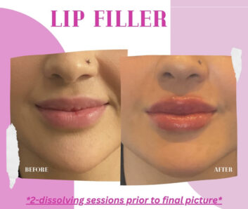 Before and After Dermal fillers at Face Works Plastic Surgery, Plastic Surgeon Near Me in Schaumburg, IL