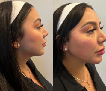 Before and After Dermal fillers at Face Works Plastic Surgery, Plastic Surgeon Near Me in Schaumburg, IL