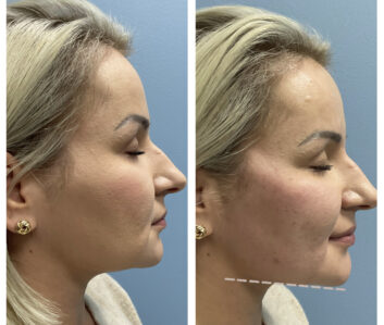 Before and After Dermal fillers at Face Works Plastic Surgery, Plastic Surgeon Near Me in Schaumburg, IL