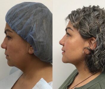 Before and After Dermal fillers at Face Works Plastic Surgery, Plastic Surgeon Near Me in Schaumburg, IL