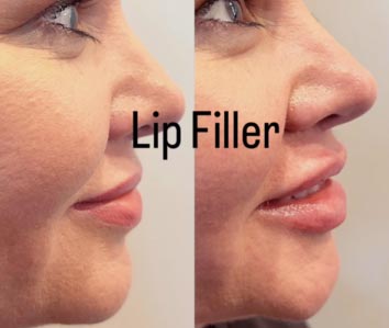 Before and After Dermal fillers at Face Works Plastic Surgery, Plastic Surgeon Near Me in Schaumburg, IL