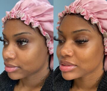 Before and After Dermal fillers at Face Works Plastic Surgery, Plastic Surgeon Near Me in Schaumburg, IL