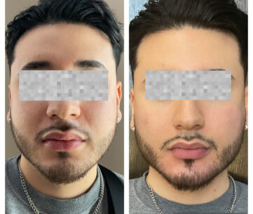 Before and After Dermal fillers at Face Works Plastic Surgery, Plastic Surgeon Near Me in Schaumburg, IL