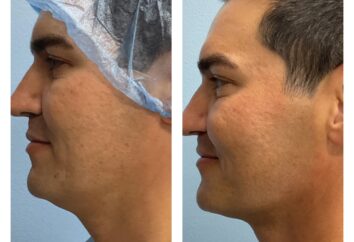 Before and After HD LipoX® of Jawline at Face Works Plastic Surgery, Plastic Surgeon Near Me in Schaumburg, IL Before and After HD LipoX® of Jawline at Face Works Plastic Surgery, Plastic Surgeon Near Me in Schaumburg, IL