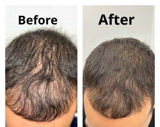 Before and After Hair Transplant/Restoration (Exosome or PRP) at Face Works Plastic Surgery, Plastic Surgeon Near Me in Schaumburg, IL