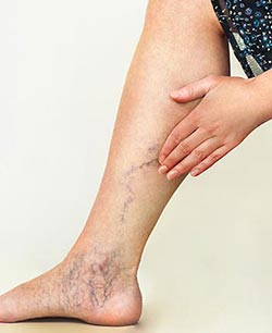 Varicose Veins (Phlebotomy) Near Me in Schaumburg, IL Varicose Veins (Phlebotomy) Near Me in Schaumburg, IL