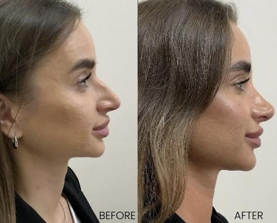 Before and After Nose Plastic Surgery at Face Works Plastic Surgery, Near Me in Schaumburg, IL