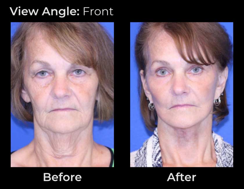Face Lift at Face Works Plastic Surgery, Plastic Surgeon Near Me in Schaumburg, IL