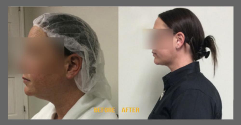 Before and After HD LipoX® of Jawline at Face Works Plastic Surgery, Plastic Surgeon Near Me in Schaumburg, IL Before and After HD LipoX® of Jawline at Face Works Plastic Surgery, Plastic Surgeon Near Me in Schaumburg, IL