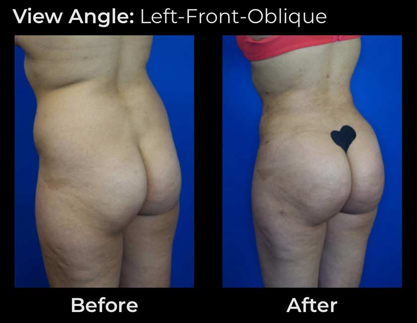 Brazilian Butt Lift at Face Works Plastic Surgery, Plastic Surgeon Near Me in Schaumburg, IL