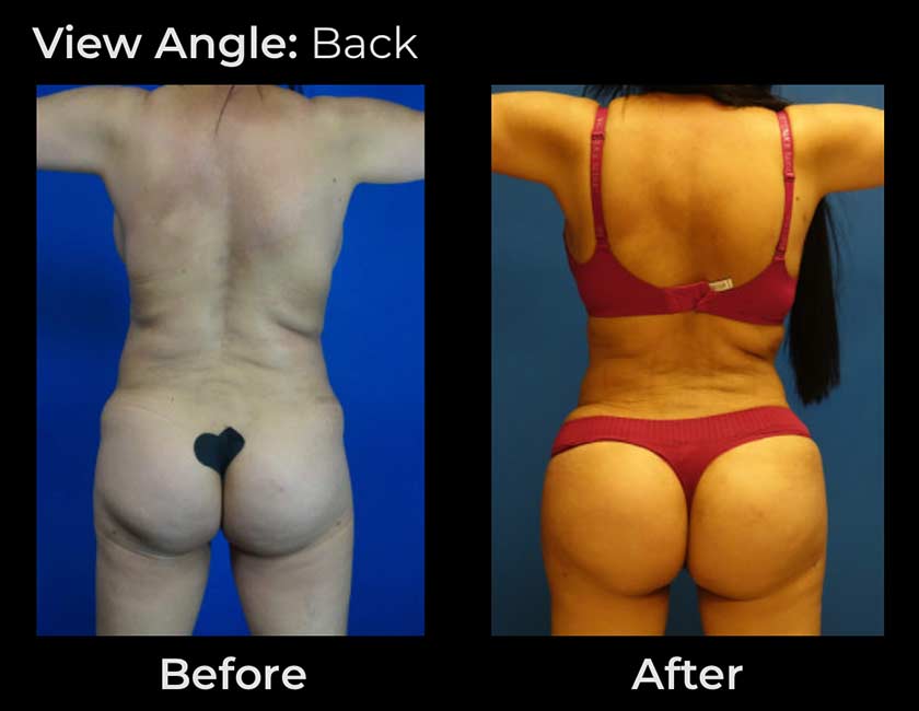 Brazilian Butt Lift at Face Works Plastic Surgery, Plastic Surgeon Near Me in Schaumburg, IL