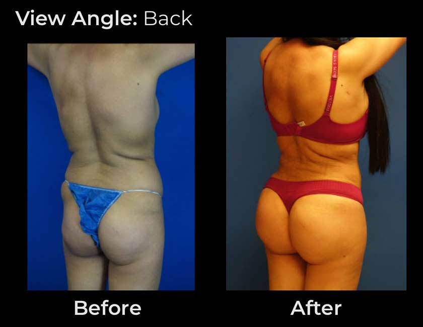 Brazilian Butt Lift at Face Works Plastic Surgery, Plastic Surgeon Near Me in Schaumburg, IL