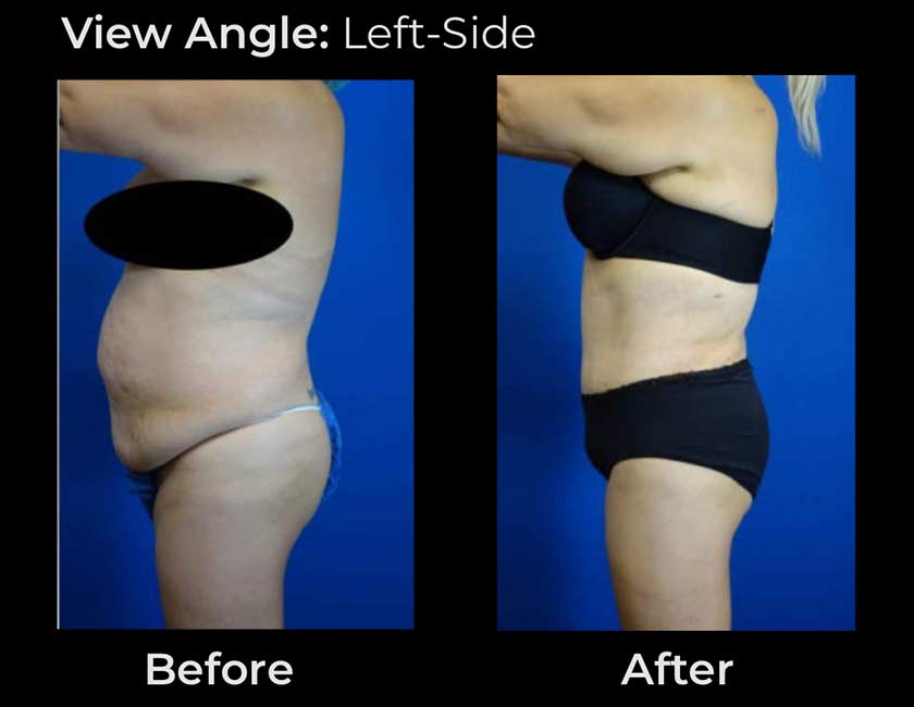 Tummy Tuck at Face Works Plastic Surgery, Plastic Surgeon Near Me in Schaumburg, IL Tummy Tuck at Face Works Plastic Surgery, Plastic Surgeon Near Me in Schaumburg, IL