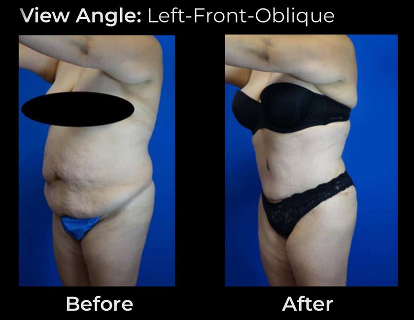 Tummy Tuck at Face Works Plastic Surgery, Plastic Surgeon Near Me in Schaumburg, IL Tummy Tuck at Face Works Plastic Surgery, Plastic Surgeon Near Me in Schaumburg, IL