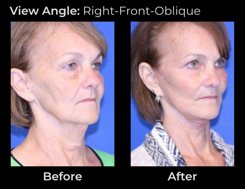 Face Lift at Face Works Plastic Surgery, Plastic Surgeon Near Me in Schaumburg, IL
