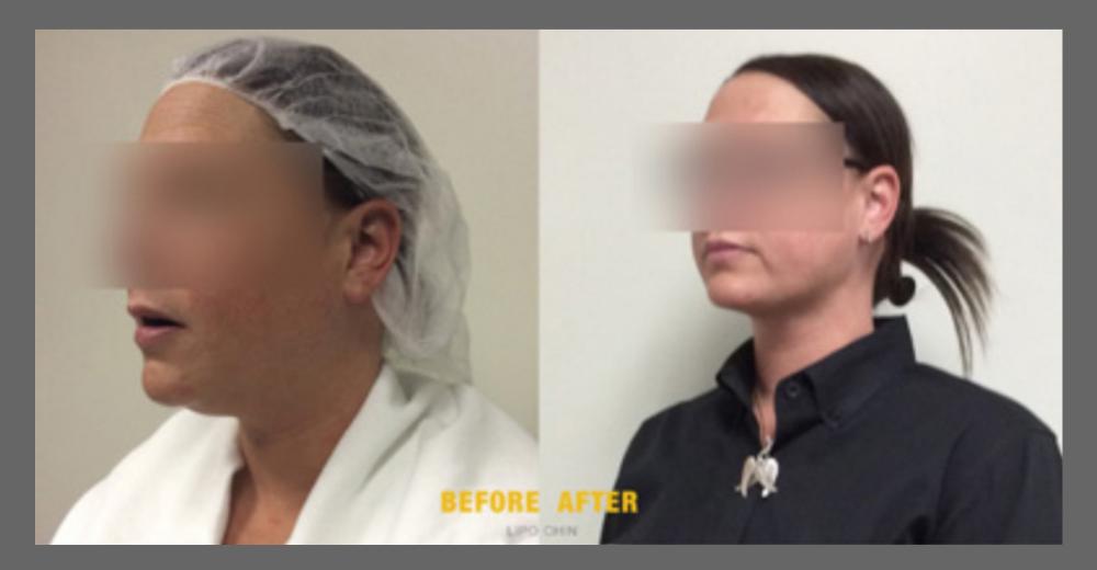 Before and After HD LipoX® of Jawline at Face Works Plastic Surgery, Plastic Surgeon Near Me in Schaumburg, IL Before and After HD LipoX® of Jawline at Face Works Plastic Surgery, Plastic Surgeon Near Me in Schaumburg, IL