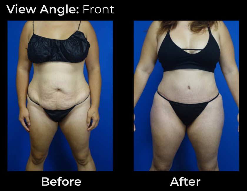Tummy Tuck at Face Works Plastic Surgery, Plastic Surgeon Near Me in Schaumburg, IL Tummy Tuck at Face Works Plastic Surgery, Plastic Surgeon Near Me in Schaumburg, IL