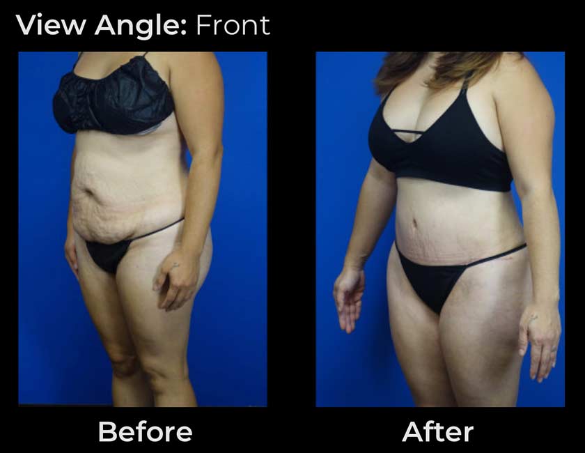 Tummy Tuck at Face Works Plastic Surgery, Plastic Surgeon Near Me in Schaumburg, IL Tummy Tuck at Face Works Plastic Surgery, Plastic Surgeon Near Me in Schaumburg, IL