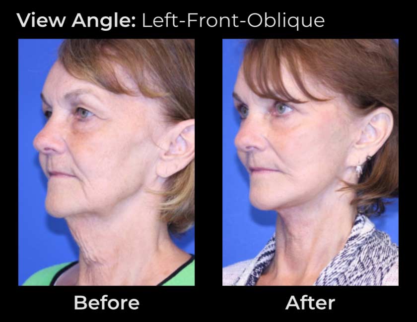 Face Lift at Face Works Plastic Surgery, Plastic Surgeon Near Me in Schaumburg, IL