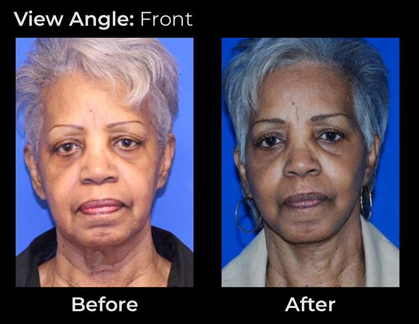 Face Lift at Face Works Plastic Surgery, Plastic Surgeon Near Me in Schaumburg, IL