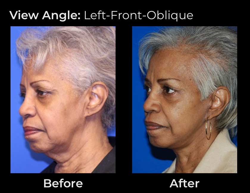 Face Lift at Face Works Plastic Surgery, Plastic Surgeon Near Me in Schaumburg, IL