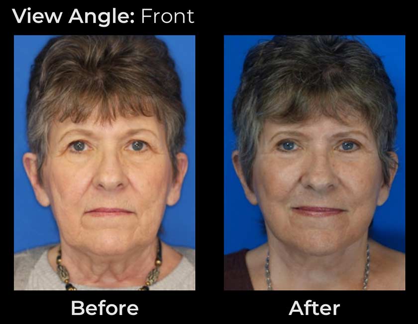 Face Lift at Face Works Plastic Surgery, Plastic Surgeon Near Me in Schaumburg, IL