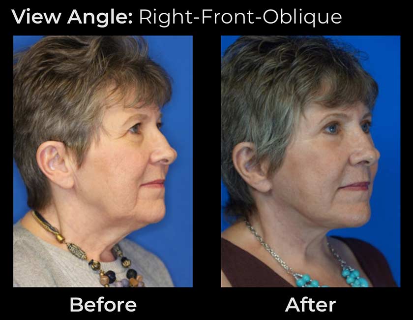 Face Lift at Face Works Plastic Surgery, Plastic Surgeon Near Me in Schaumburg, IL