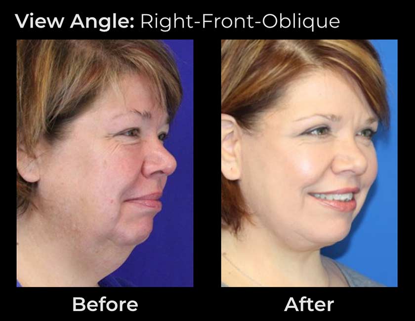 Face Lift at Face Works Plastic Surgery, Plastic Surgeon Near Me in Schaumburg, IL