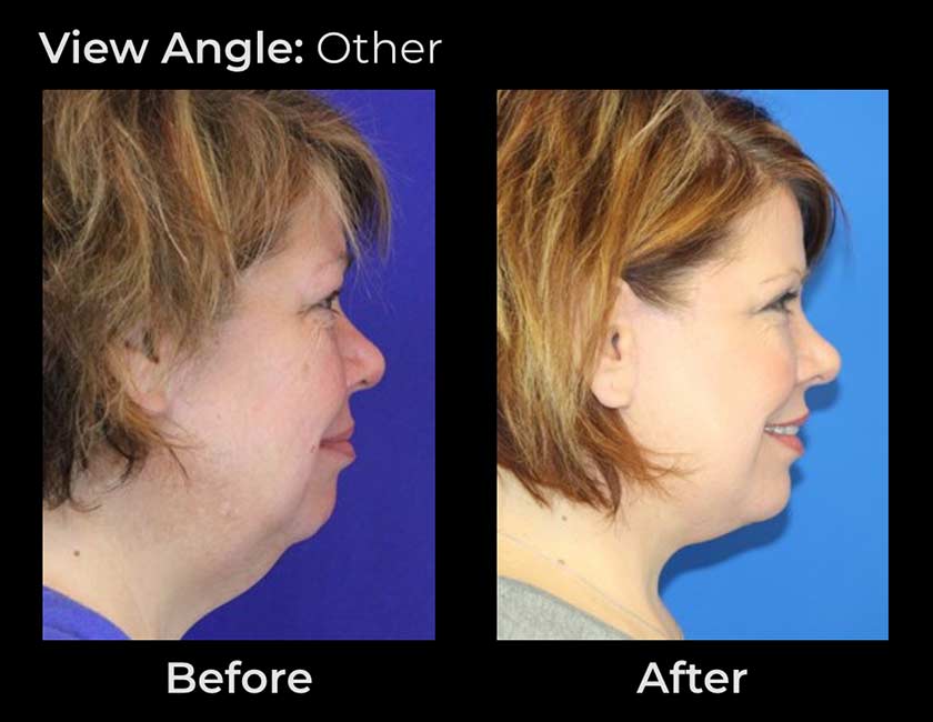 Face Lift at Face Works Plastic Surgery, Plastic Surgeon Near Me in Schaumburg, IL