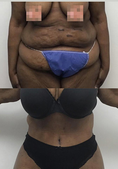 Before and After Tummy Tuck at Face Works Plastic Surgery, Plastic Surgeon Near Me in Schaumburg, IL