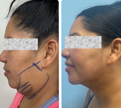 Before and After HD LipoX® of Jawline at Face Works Plastic Surgery, Plastic Surgeon Near Me in Schaumburg, IL Before and After HD LipoX® of Jawline at Face Works Plastic Surgery, Plastic Surgeon Near Me in Schaumburg, IL