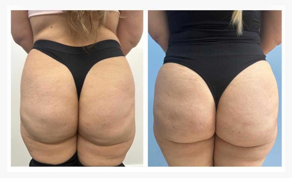 Before and After Liquid Butt Lift at Face Works Plastic Surgery, Plastic Surgeon Near Me in Schaumburg, IL Before and After Liquid Butt Lift at Face Works Plastic Surgery, Plastic Surgeon Near Me in Schaumburg, IL