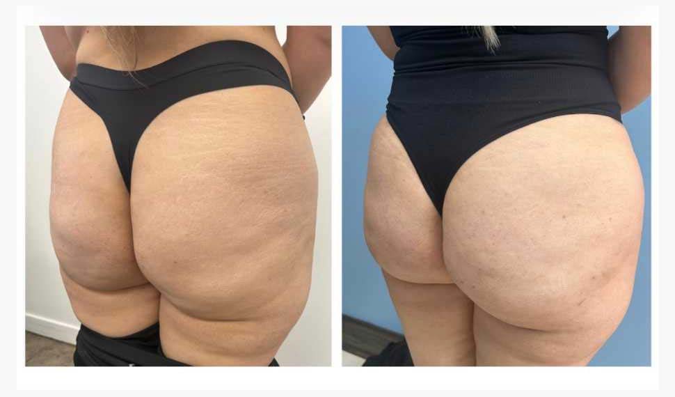 Before and After Liquid Butt Lift at Face Works Plastic Surgery, Plastic Surgeon Near Me in Schaumburg, IL Before and After Liquid Butt Lift at Face Works Plastic Surgery, Plastic Surgeon Near Me in Schaumburg, IL