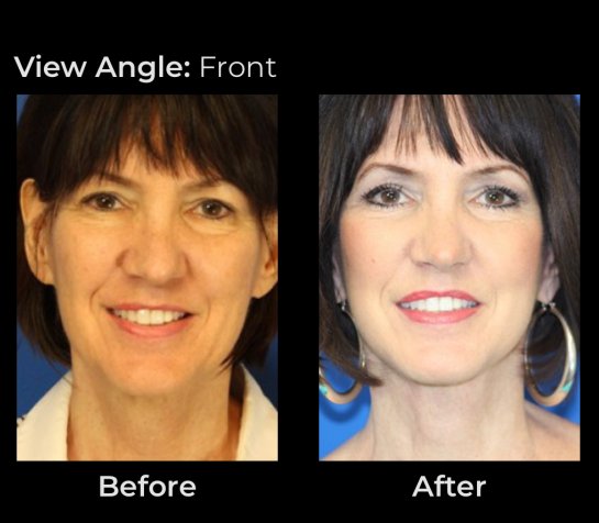 Eyelids Plastic Surgery at Face Works Plastic Surgery, Plastic Surgeon Near Me in Schaumburg, IL Eyelids Plastic Surgery at Face Works Plastic Surgery, Plastic Surgeon Near Me in Schaumburg, IL