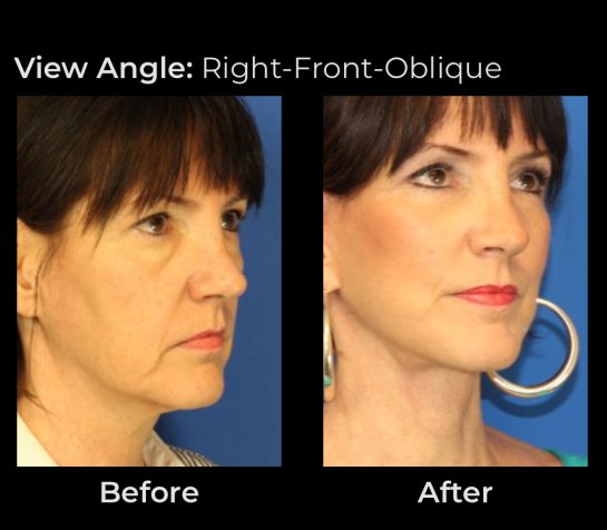 Eyelids Plastic Surgery at Face Works Plastic Surgery, Plastic Surgeon Near Me in Schaumburg, IL Eyelids Plastic Surgery at Face Works Plastic Surgery, Plastic Surgeon Near Me in Schaumburg, IL