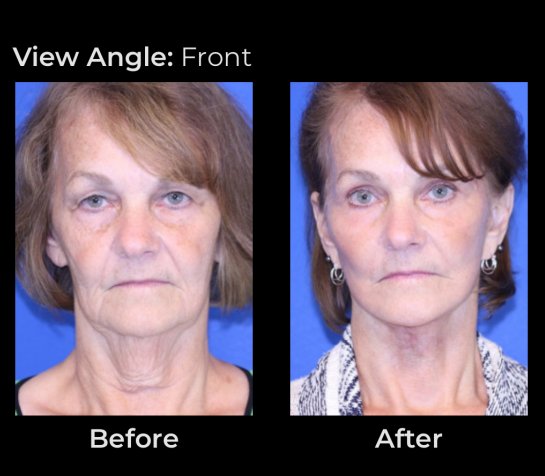 Eyelids Plastic Surgery at Face Works Plastic Surgery, Plastic Surgeon Near Me in Schaumburg, IL Eyelids Plastic Surgery at Face Works Plastic Surgery, Plastic Surgeon Near Me in Schaumburg, IL