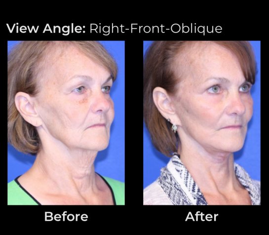 Eyelids Plastic Surgery at Face Works Plastic Surgery, Plastic Surgeon Near Me in Schaumburg, IL Eyelids Plastic Surgery at Face Works Plastic Surgery, Plastic Surgeon Near Me in Schaumburg, IL