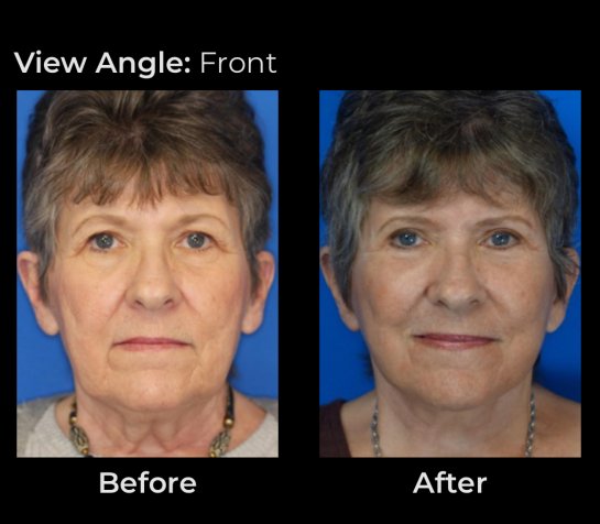 Eyelids Plastic Surgery at Face Works Plastic Surgery, Plastic Surgeon Near Me in Schaumburg, IL Eyelids Plastic Surgery at Face Works Plastic Surgery, Plastic Surgeon Near Me in Schaumburg, IL